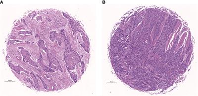 Increases prognostic value of clinical-pathological nomogram in patients with esophageal squamous cell carcinoma
